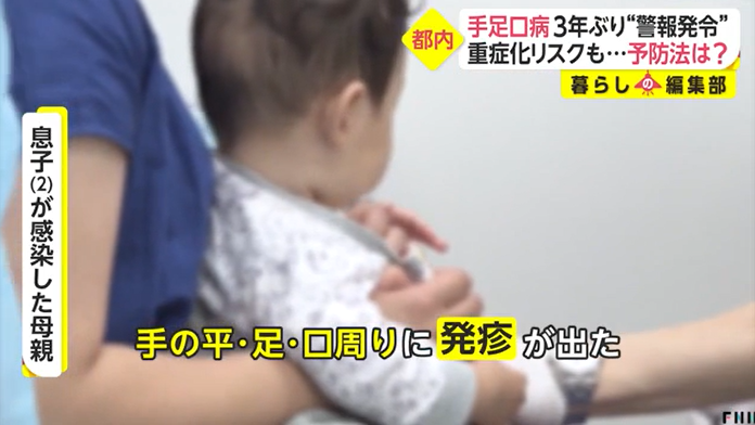 日本手足口病患者激增：確診者幼兒居多 呈重癥化傾向
