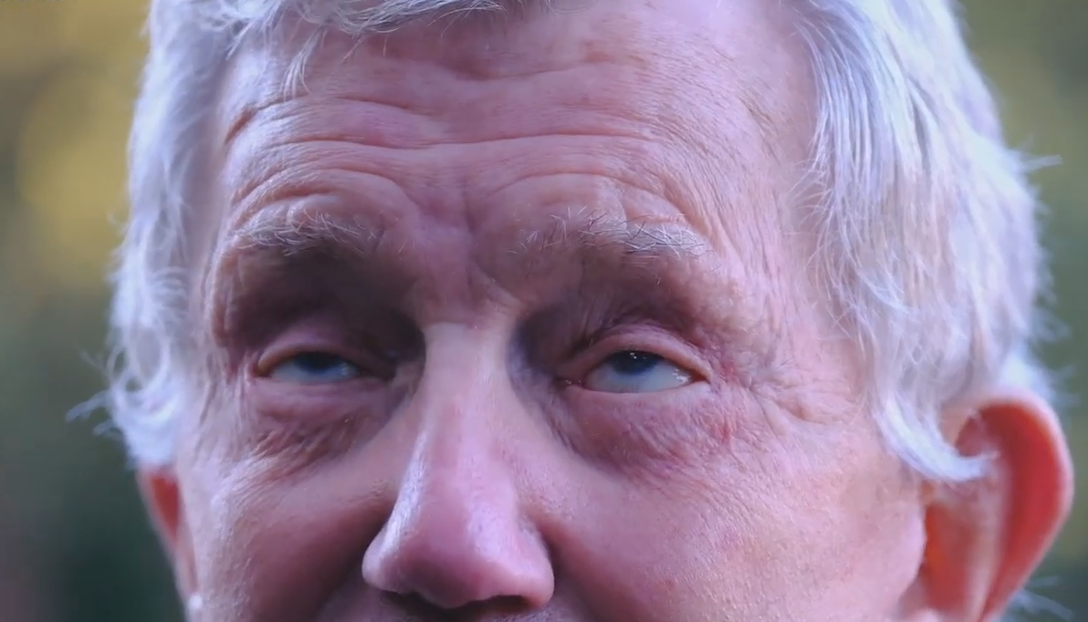 英国一79岁老人整容手术失败导致左眼三年无法闭上