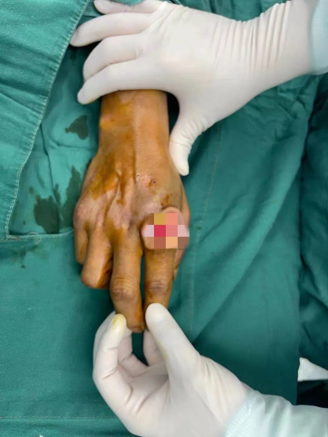 “皮肤”“手痒”2年，竟然是癌？！高温天里更要警惕这件事！