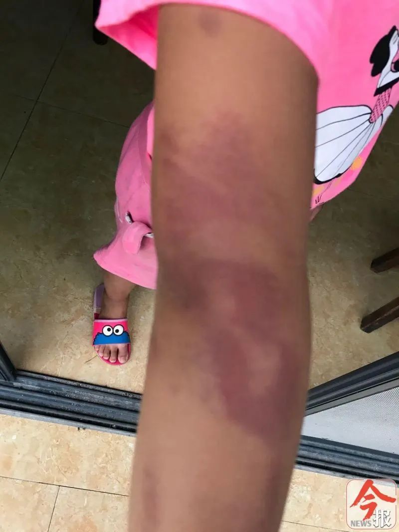 柳州一小学女生身上多处淤青，家长称遭老师殴打！校方：警方已介入
