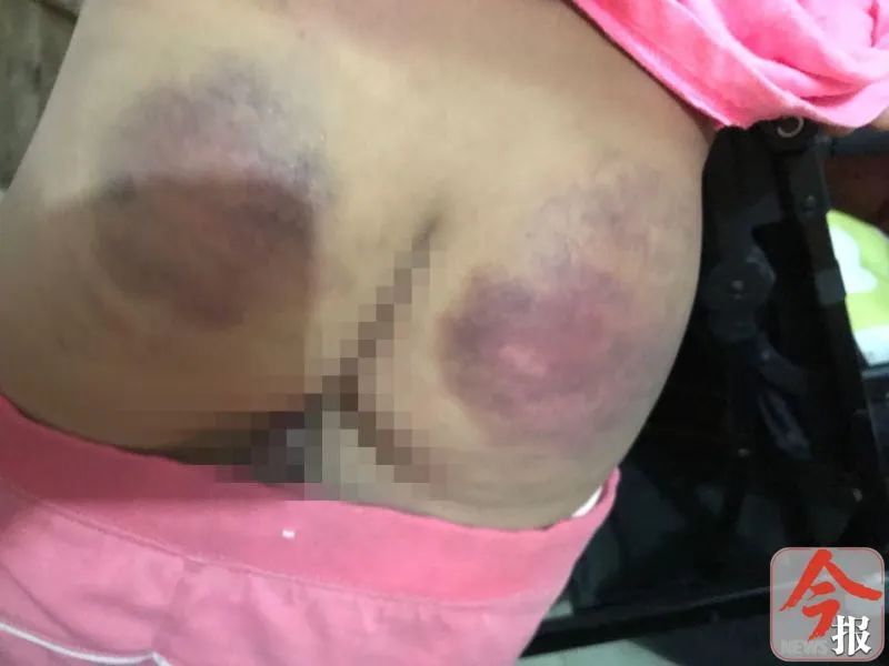 柳州一小学女生身上多处淤青，家长称遭老师殴打！校方：警方已介入